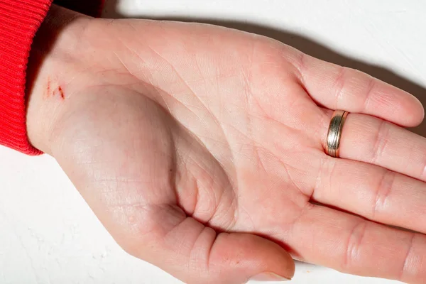 小さな傷を持つ女性の手 ウェディングリング付きの女性の手 — ストック写真