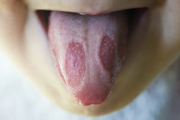 Geographic tongue disease in a child — Stock Photo, Image