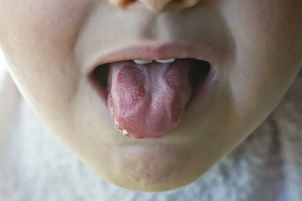 Географическое заболевание языка у ребенка — стоковое фото