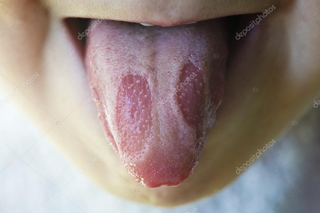 Geographic tongue disease in a child