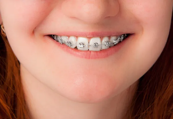 Dental care concept. Teeth with braces — Stock Photo, Image