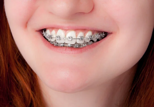 Dental care concept. Teeth with braces — Stock Photo, Image