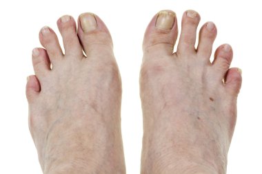 ayaklar ve kırık tırnak