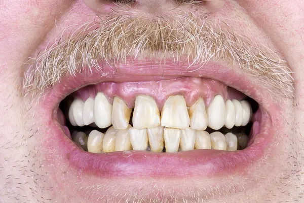 Dientes amarillos estudio disparo — Foto de Stock