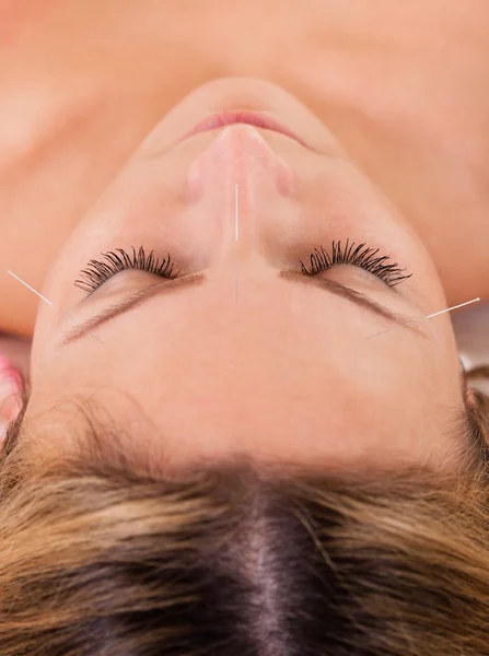 Mujer en tratamiento de acupuntura — Foto de Stock