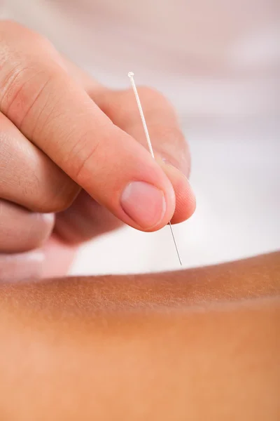 Acupuncture needle inserted — Stock Photo, Image