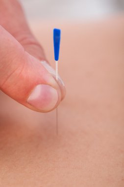 Bir akupunktur tedavisi bir spa merkezi