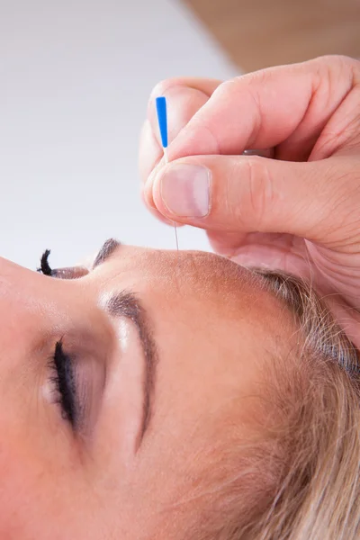 Woman Receiving An Acupuncture Therapy — Stock Photo, Image