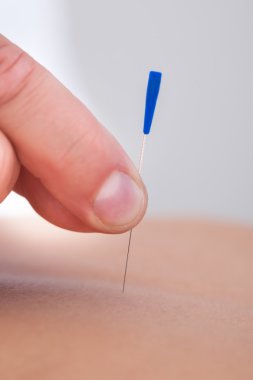 Bir akupunktur tedavisi bir spa merkezi