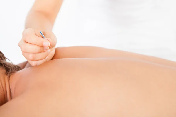 Hombre recibiendo tratamiento de acupuntura — Foto de Stock