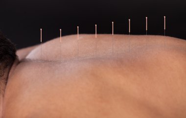 adam Başlarken akupunktur tedavisi