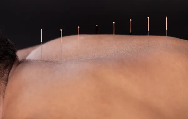 Mann erhält Akupunktur-Behandlung — Stockfoto