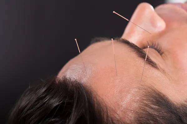 Man Undergoing Acupuncture Treatment — Stock Photo, Image