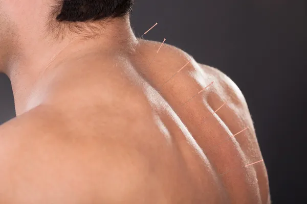 Muž s akupunkturní jehly na zádech — Stock fotografie