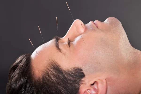 Man Undergoing Acupuncture Treatment — Stock Photo, Image