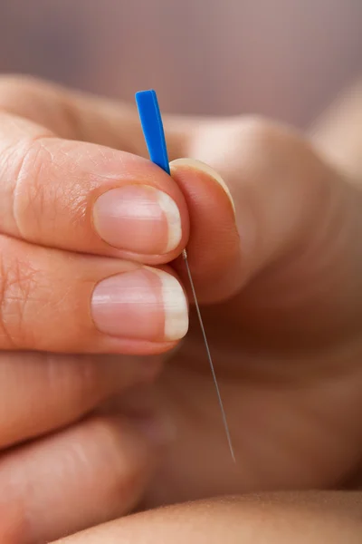 Terapeuta realizando tratamento de acupuntura — Fotografia de Stock