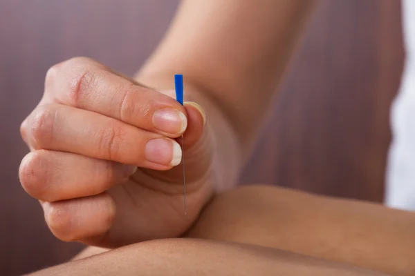 Terapeuta realizando tratamento de acupuntura — Fotografia de Stock