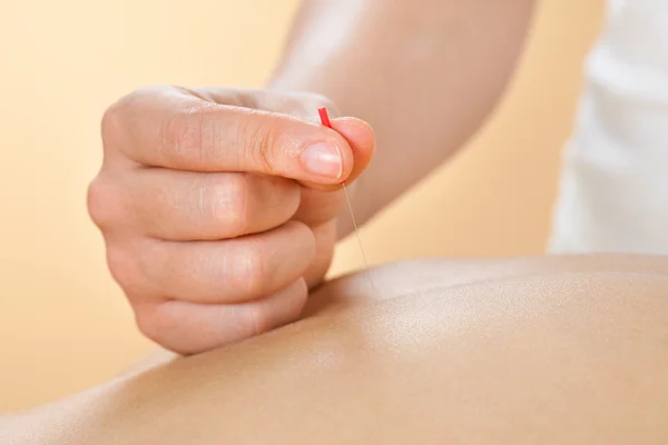 Therapeutin gibt Akupunktur-Behandlung für Frau im Wellnessbereich — Stockfoto