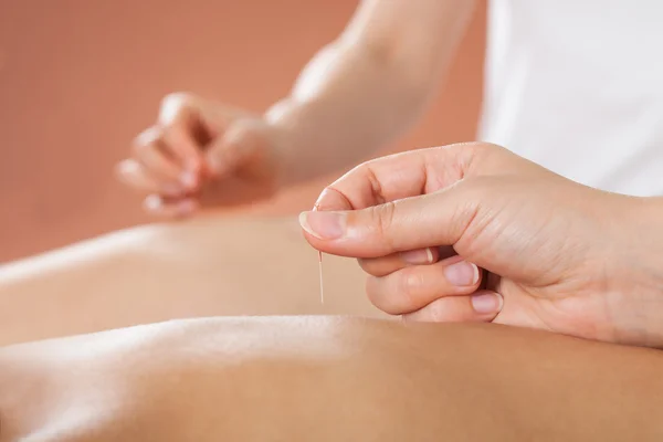 Couple Receiving Acupuncture Treatment At Spa — Stock Photo, Image