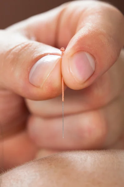 Woman Receiving Acupuncture Treatment — Stock Photo, Image