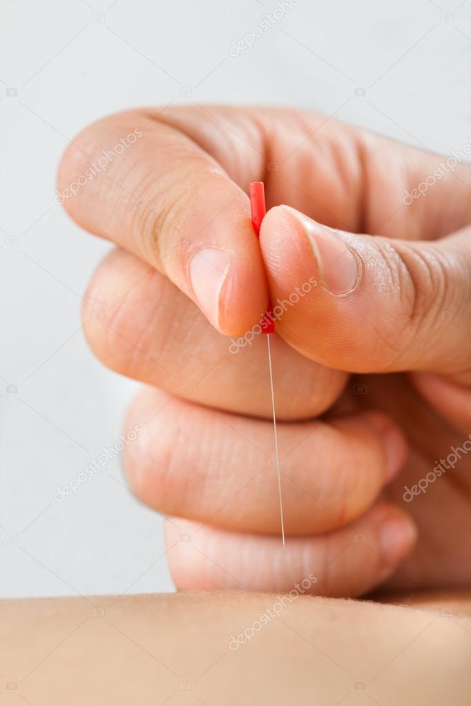 Therapist Giving Acupuncture Treatment