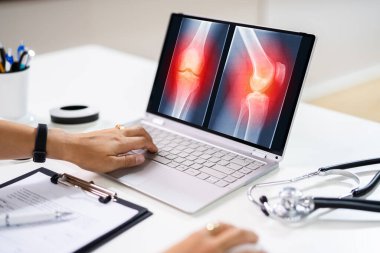 Cerrah Doktor Knee Xray Kemik Tarama Yazılım Teknolojisini Kullanıyor