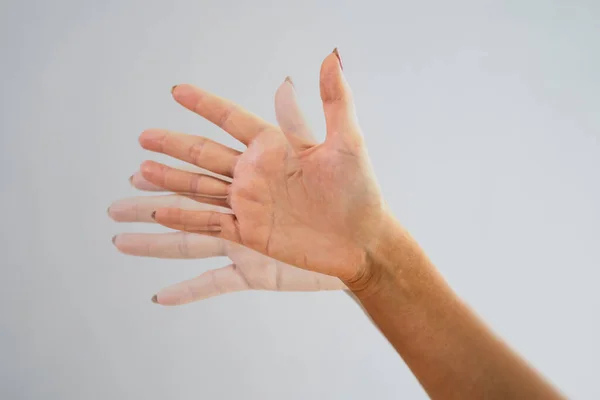 Persoon Hand Met Dystonie Degeneratieve Vergrijzing Beweging — Stockfoto