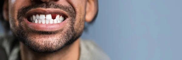 Foto Cerca Hombre Joven Con Dientes Perdidos —  Fotos de Stock