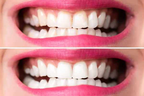 Close Dos Dentes Uma Mulher Sorridente Antes Depois Clareamento — Fotografia de Stock