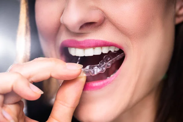 Beyaz Dişleriyle Saydam Hizalayıcıları Ayarlayan Bir Kadının Yakın Çekimi — Stok fotoğraf