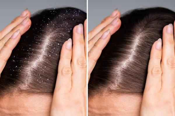 Diferencia Cabello Con Caspa Cabello Limpio — Foto de Stock