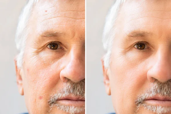 Foto Procedure Invecchiamento Sul Viso Dell Uomo Caucasico — Foto Stock