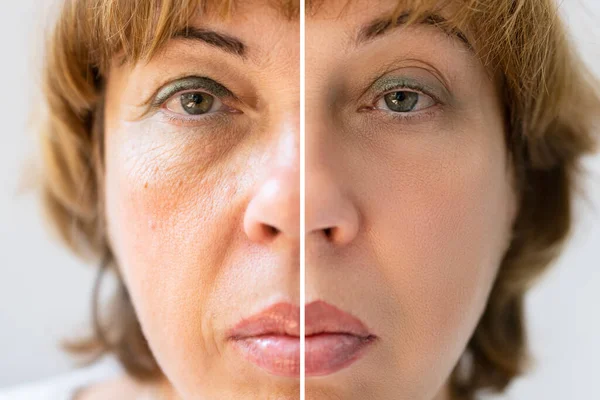 Photo Aging Procedures Caucasian Woman Face — Stock Photo, Image