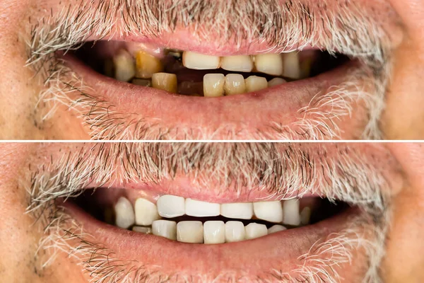 Крупный План Человека Зубами — стоковое фото