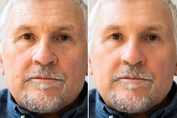 Photo Of Anti-aging Procedures On Caucasian Man Face