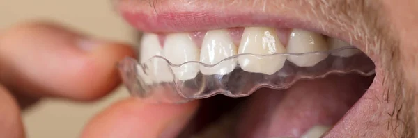 一个人把透明对齐器放进牙齿的特写 — 图库照片