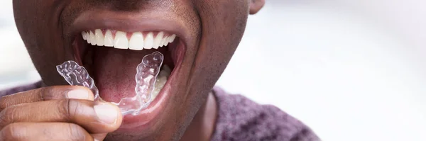 一个男人的特写在他洁白的牙齿上调节透明的直线对准器 — 图库照片