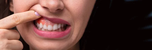 Close Van Een Vrouw Vinger Weergegeven Zwelling Van Haar Tandvlees — Stockfoto