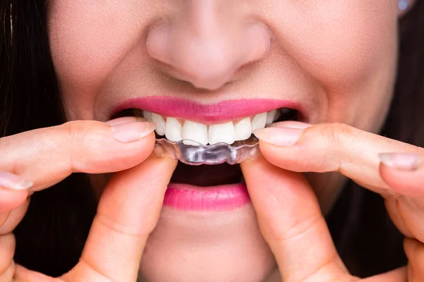 Primer Plano Mano Una Mujer Poniendo Alineador Transparente Los Dientes — Foto de Stock