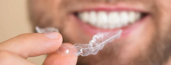 Close Man Hand Holding Transparent Aligner — Stock Photo, Image