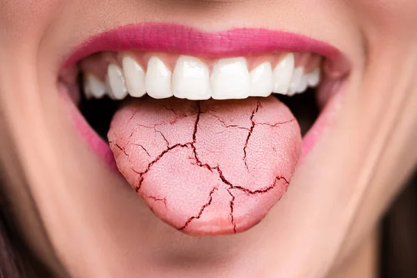 Dolor Lengua Seco Grietas Candidiasis Oral — Foto de Stock