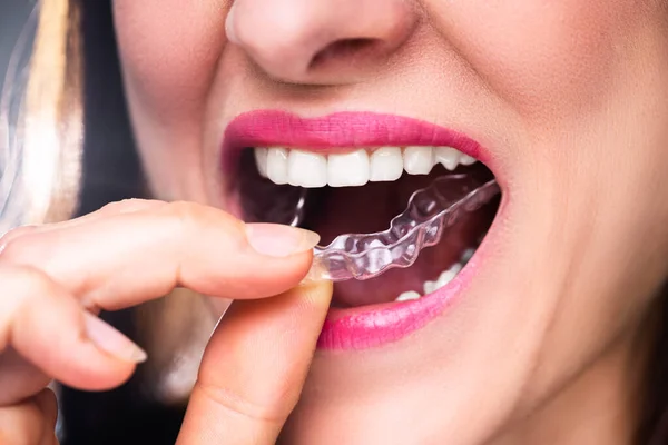 Primer Plano Mano Una Mujer Poniendo Alineador Transparente Los Dientes — Foto de Stock