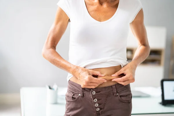 Lipoaspiração Dieta Gordura Estômago Pinça Pele Estômago — Fotografia de Stock