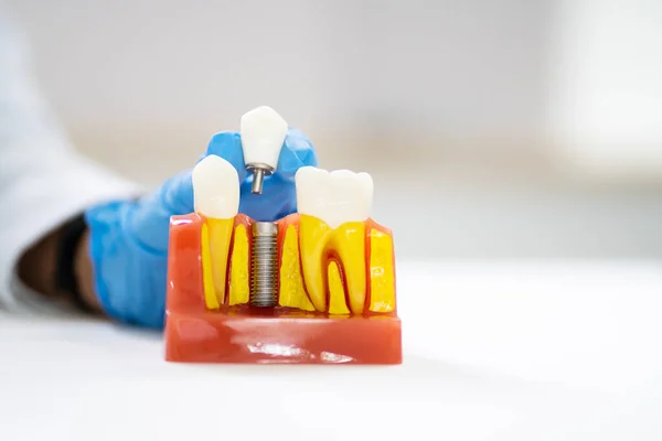 歯科インプラントと歯治療技術 クラウンメタル — ストック写真