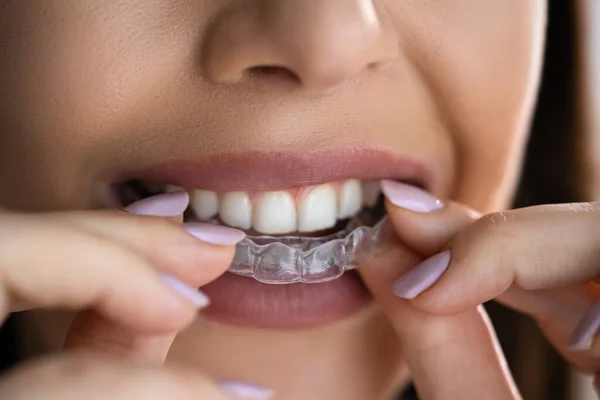 Clear Aligner Stomatologia Nocna Dla Zębów — Zdjęcie stockowe