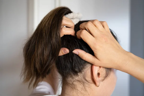 Young Woman Scratching Her Itchy Head Scalp — Stock Photo, Image