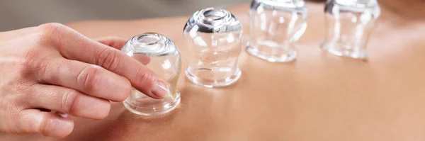 Cupping Terapi Med Hjälp Vakuum Kinesiskt Glas Bägare Massage — Stockfoto