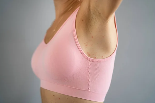 Erupção Cutânea Corpo Mulher Com Alergia Vermelha — Fotografia de Stock