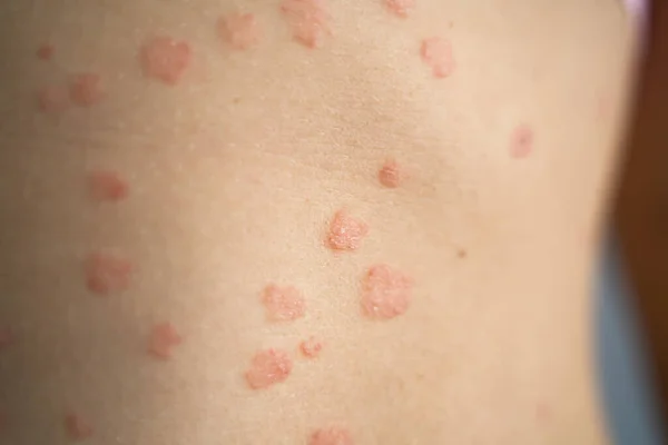 Piel Corporal Con Psoriasis Enfermedad Autoinmune Enfermedad Médica — Foto de Stock