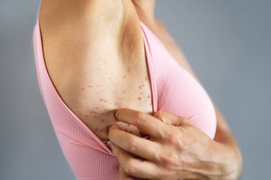 Kaşındıran Kıymık Derisi. Hassas Egzama Kızarıklığı ve Dermatit